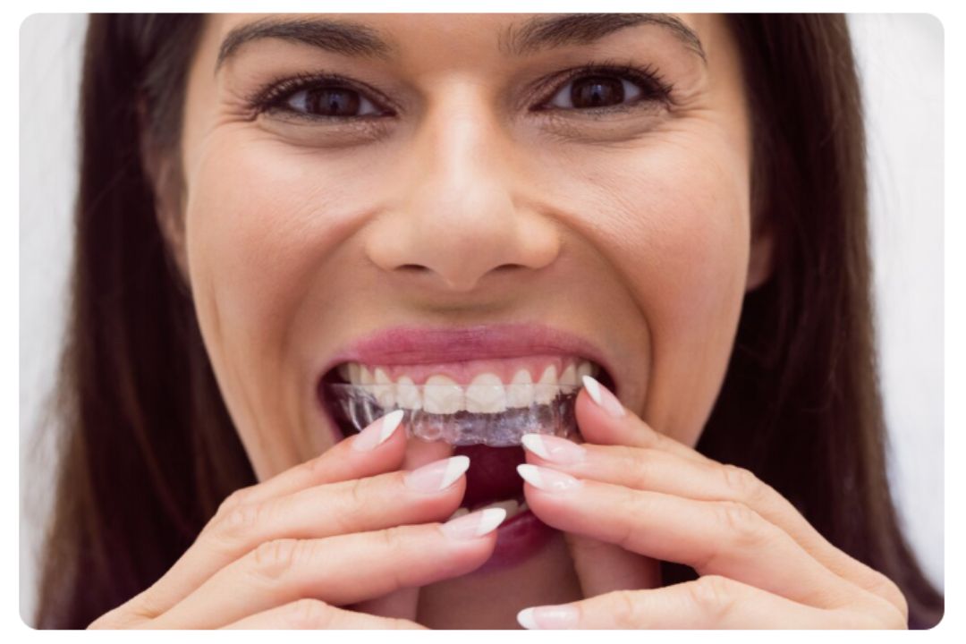 teeth aligners cost in mumbai